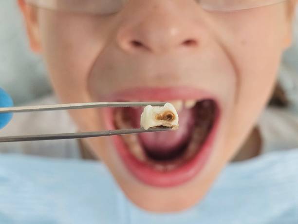 Best Emergency Wisdom Teeth Removal in Hopelawn, NJ